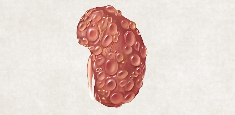 Polycystic Kidney Disease Service